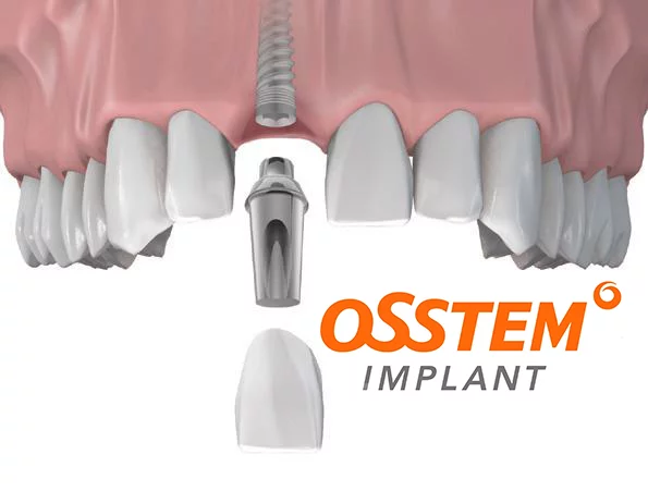 Имплантаты OSSTEM